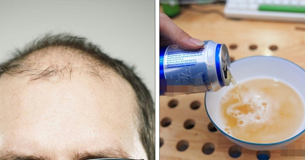 Shampooing with a can of beer helps with hair loss and getting rid of dandruff