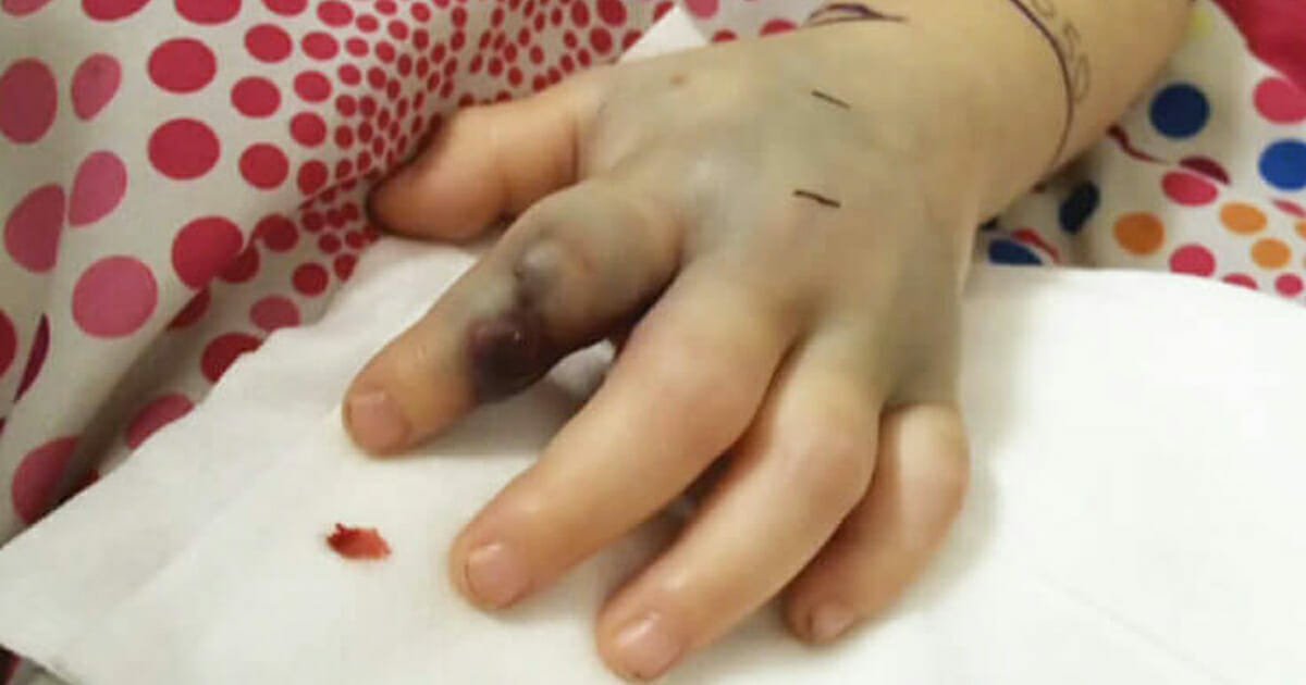 2-year-old girl's hand suddenly swells and darkens, flown to hospital after playground incident