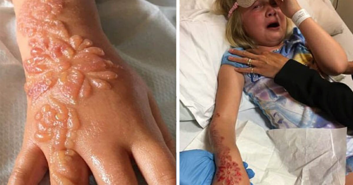 Parents issue warning as 7-year-old left with blisters, burns and scarring after family vacation