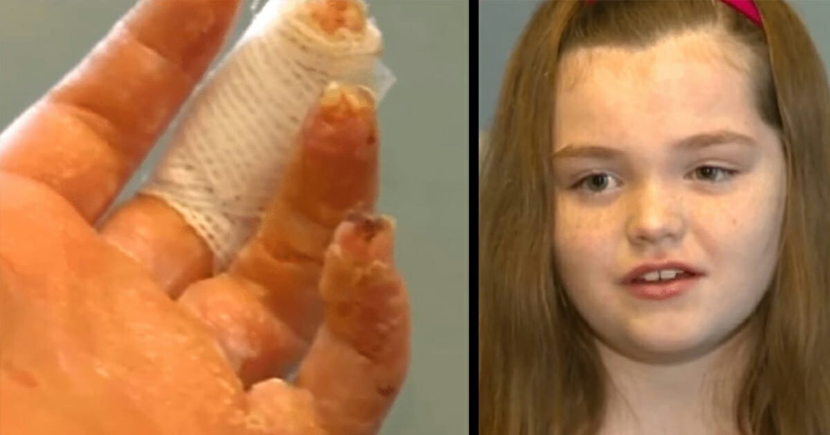 Young girl left with serious burns after taking part in recent schoolyard trend, and she's not the only one