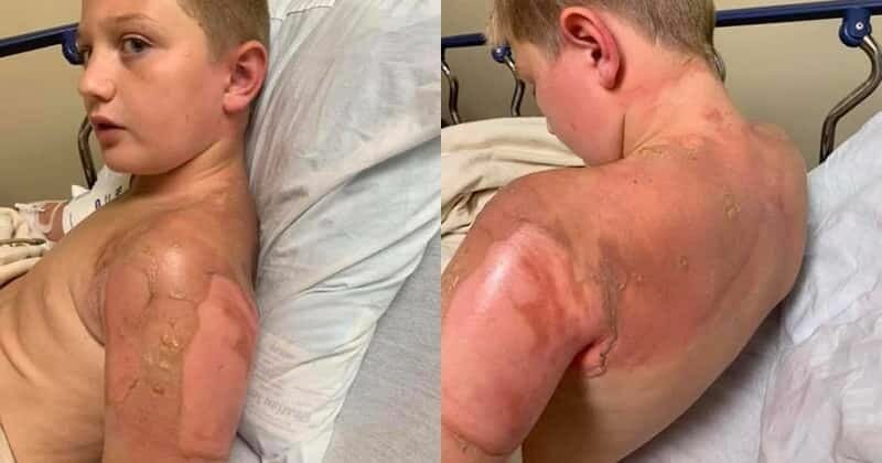 11-year boy wakes up with horrific burns after friend pours boiling hot water on him
