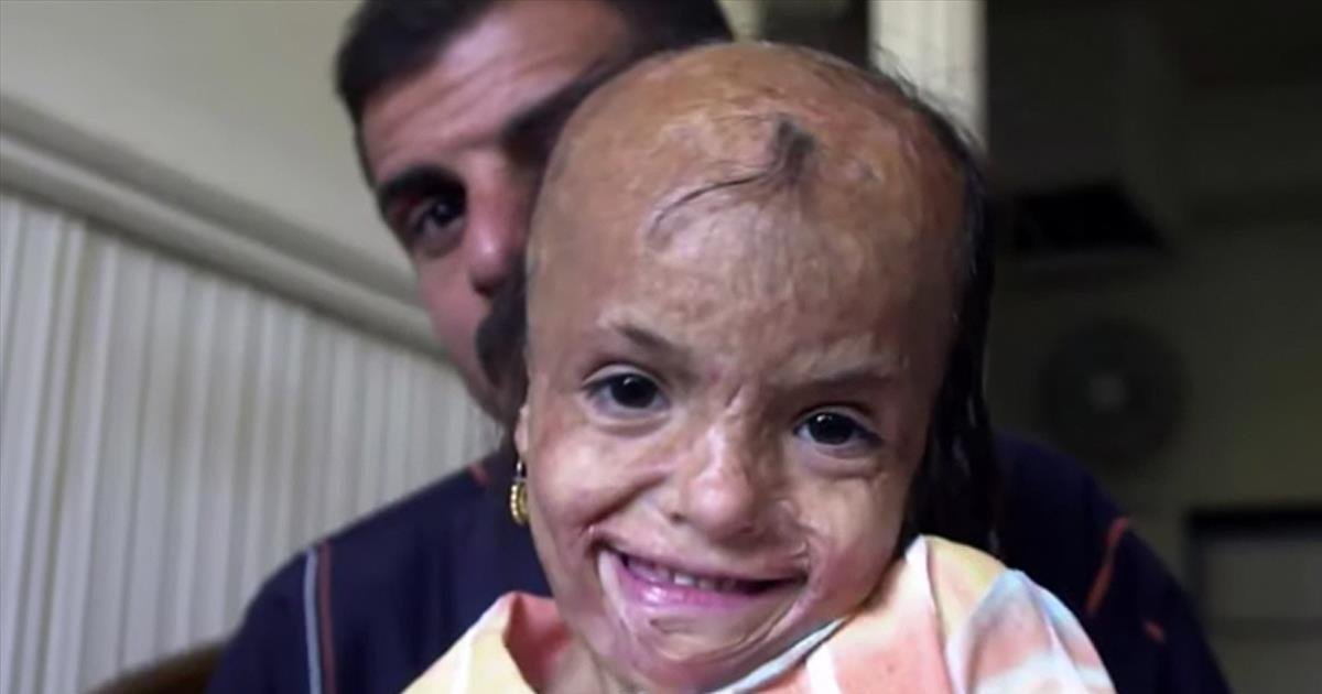 Badly scarred 5-year-old girl receives care after mother's selfless sacrifice