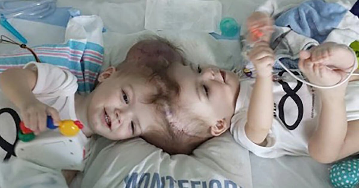 'Nothing short of a miracle': Conjoined twins separated after 27-hour surgery, growing stronger despite all odds