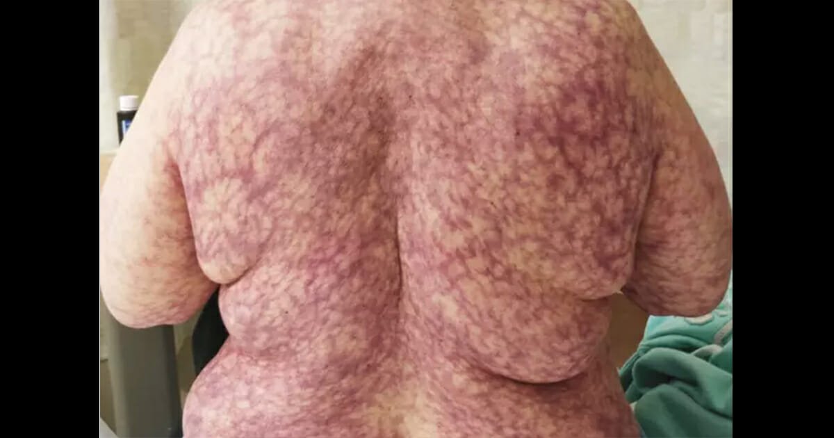 Woman develops strange, web-like purple rash after going out in cold weather