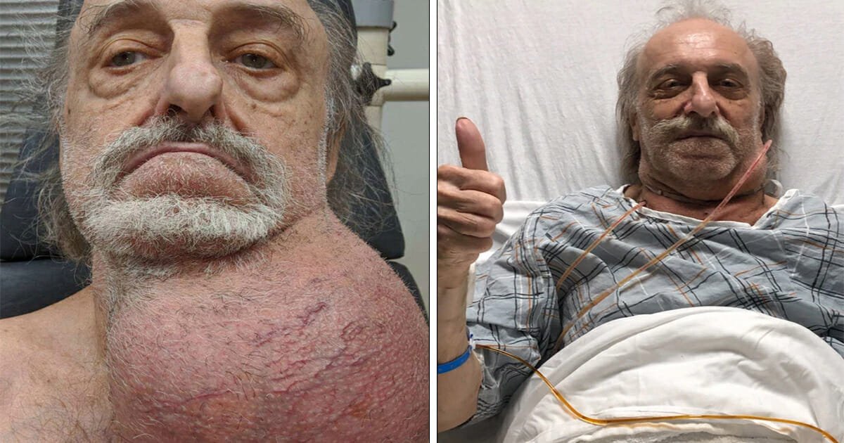 81-year-old has soccer ball-sized tumor removed from neck after months of being turned away by doctors