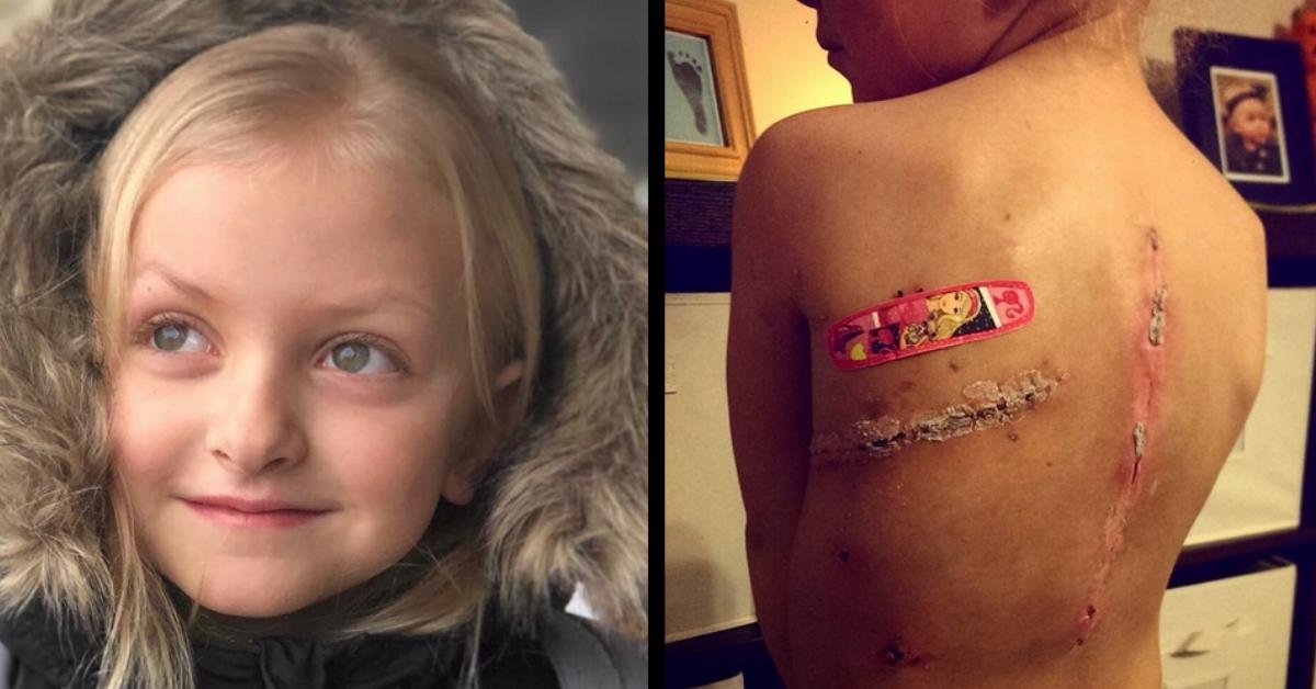 Brave 4-year-old girl beats cancer but bullies mock her scars, fed-up mom confronts her tormentors