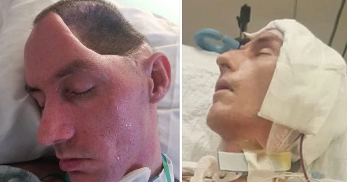 Dad of 2 paralyzed after attack leaves him with half a skull and "sunken" brain – culprit serves two months