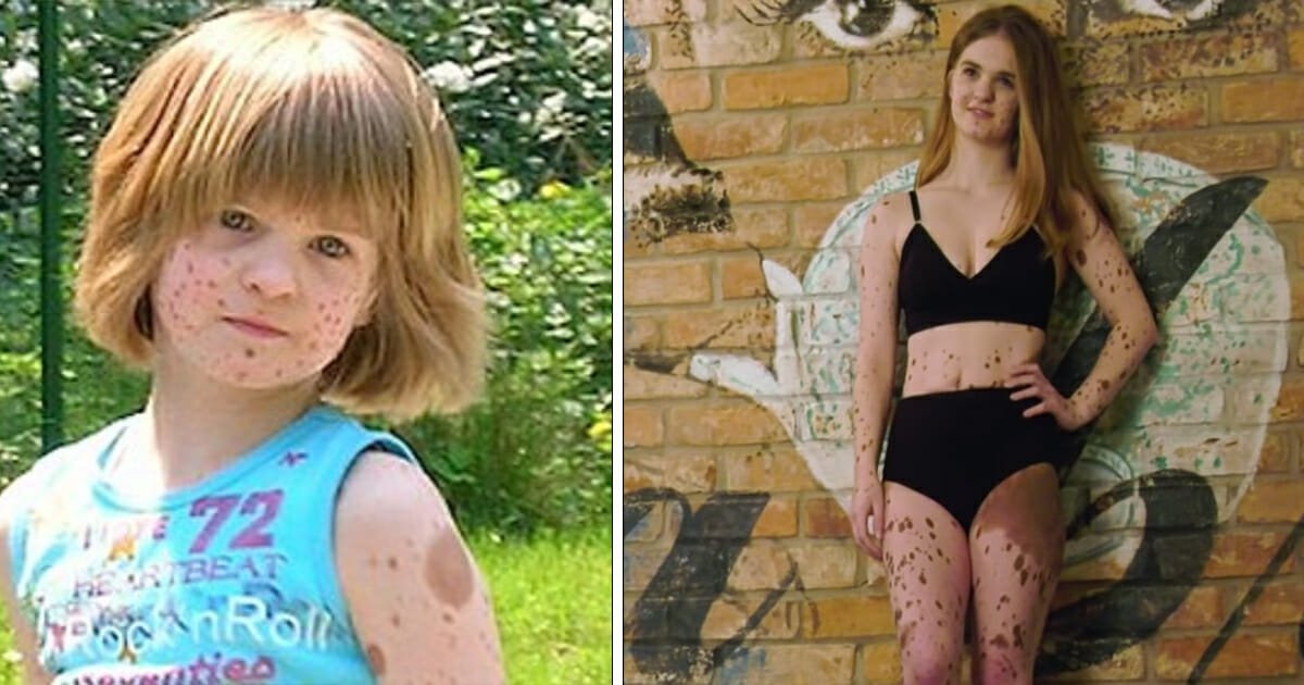 Girl born with 'spots everywhere' bullied for years, now she's a model