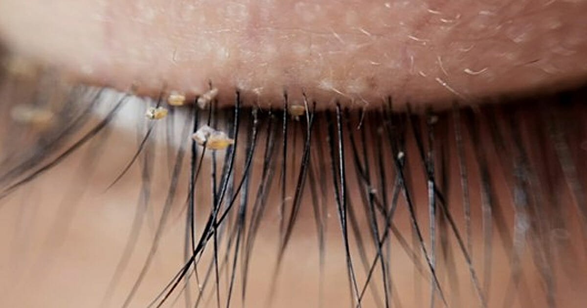 Lash lice becoming more and more common in eyelash extensions, doctors warn