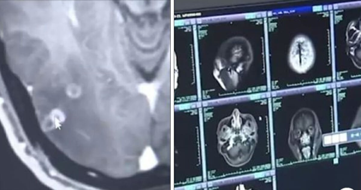 Man suffers bad headaches for months before scans show 700 tapeworms in brain, chest and lungs