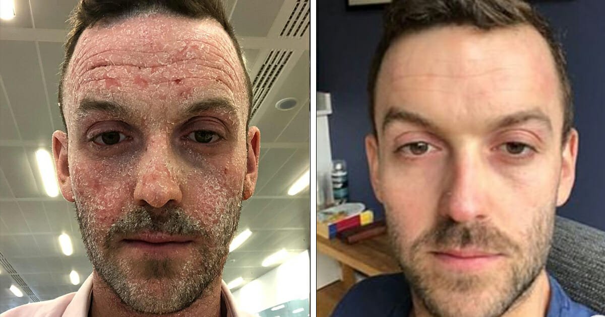 Man with eczema posts incredible transformation after ditching steroid medication