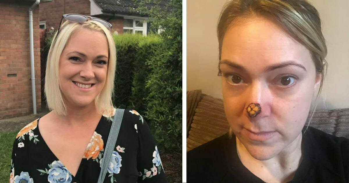 Mom sees doctor for 'harmless' spot on her nose, then told it's flesh-eating cancer