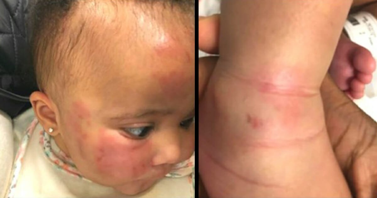 Mom trusts daycare with 6-month-old, realizes her mistake when she’s covered in bruises