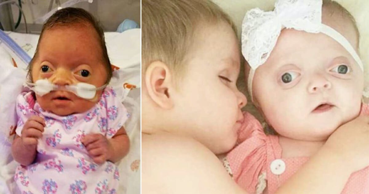 Newborn baby has skull removed but all Mom sees is a 'perfect little angel'