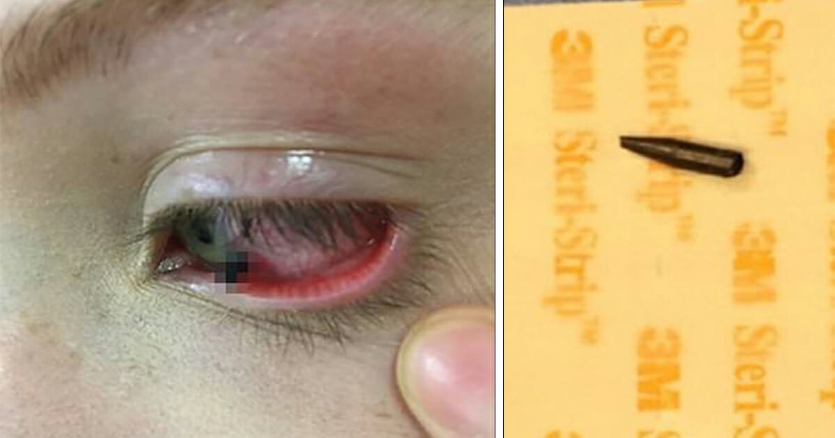 Girl sees pencil thrown across school classroom, then friend says "I think there's something in your eye"