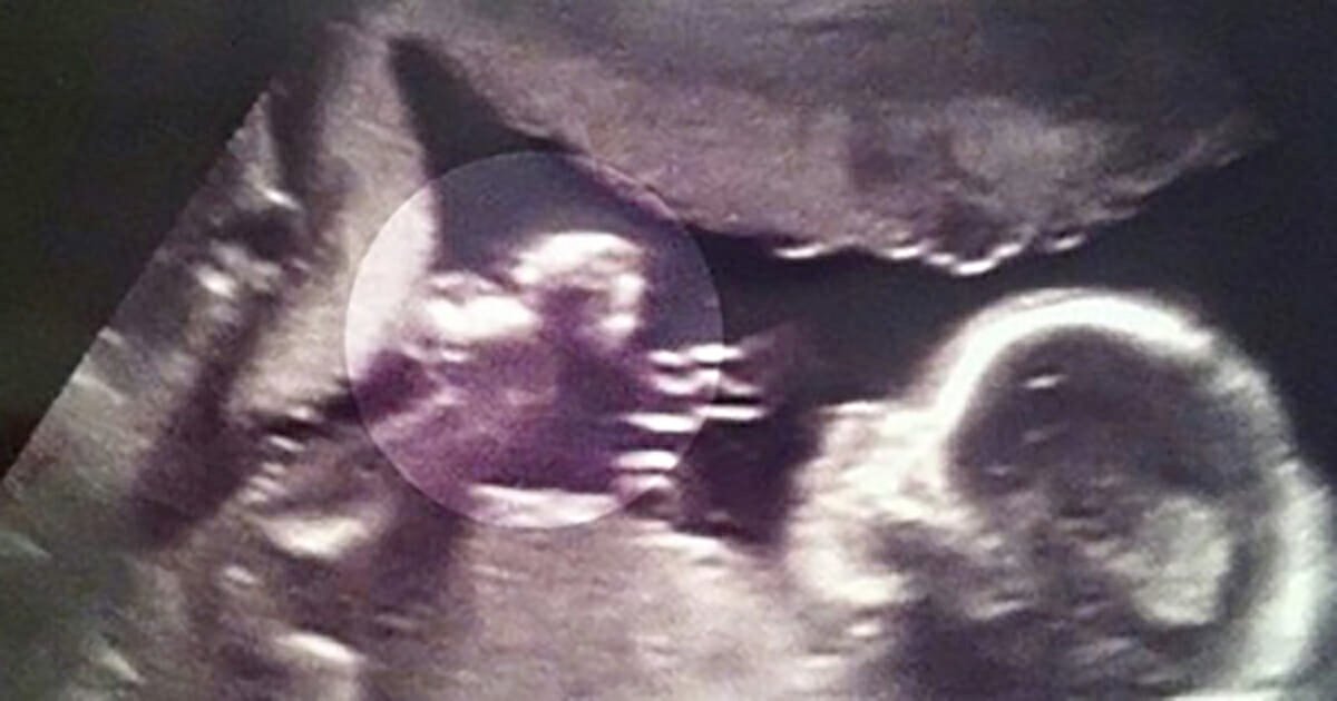 Amazing ultrasound shows ”angel” watching over unborn baby in mom’s womb