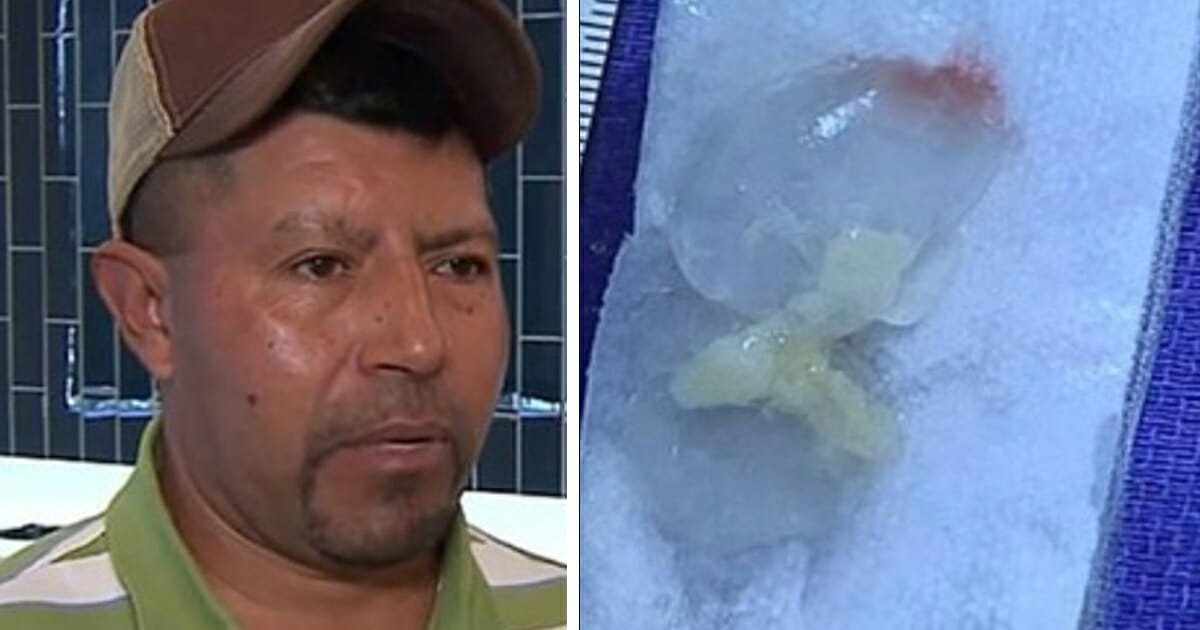 Man suffers headaches and sickness before scans show worm’s been living in his brain for 10 years
