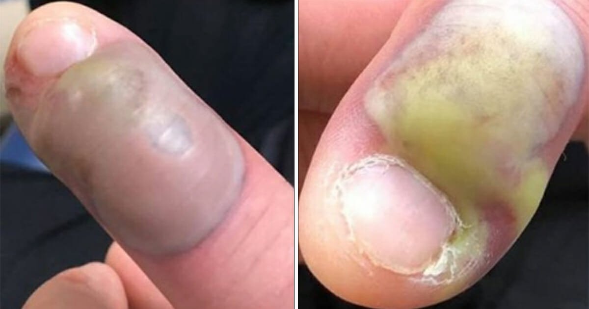 Woman hospitalized after contracting deadly infection from biting her nails