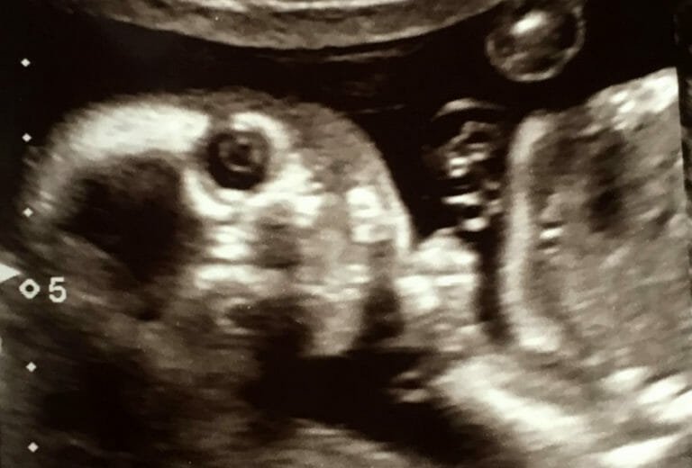Pregnant mom says unborn baby turned and stared at camera in 'creepy' 20-week scan