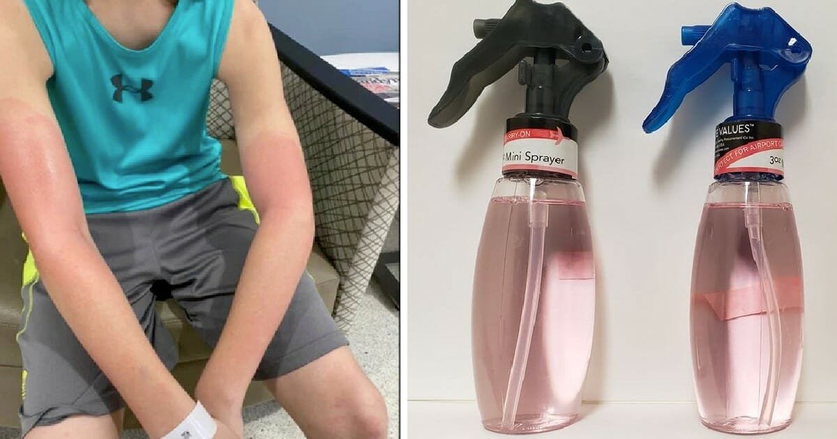 Mom issues warning after son suffers first-degree burns from 'spray sanitizer'